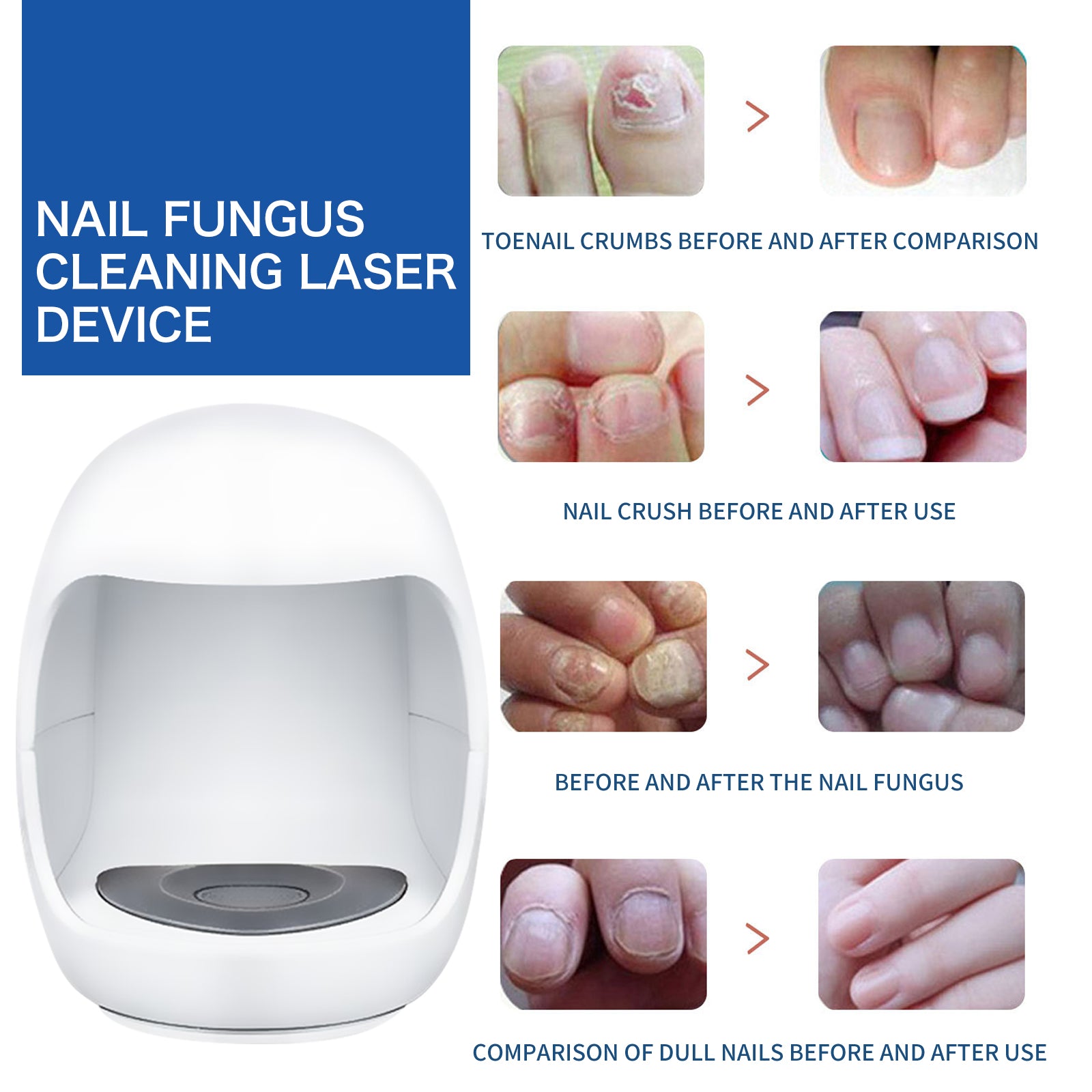 South Moon Nail Care Phototherapy Device, Repair Hands And Feet Gray Nails Yellow Ingrown Nail Soft Nail Care
